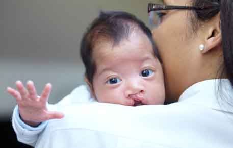 Baby with cleft lip being held by an adult.