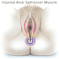 injured anal sphincter muscle